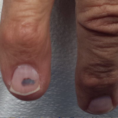 Subungual Lesion Hasn T Grown Out Benign Or Malignant Clinician Reviews