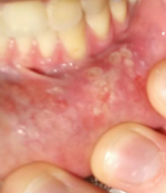 View Ulcer Under Tongue Cancer
 Images