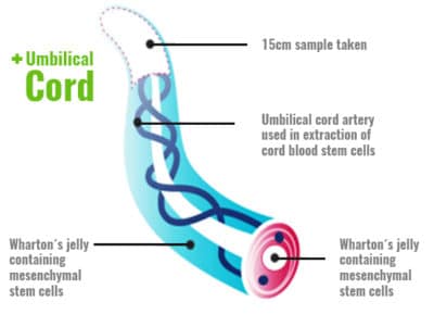 View Umbilical Cord Blood Cancer Treatment
 Images